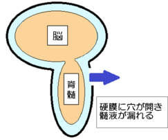 硬膜に穴が開き髄液が漏れる図